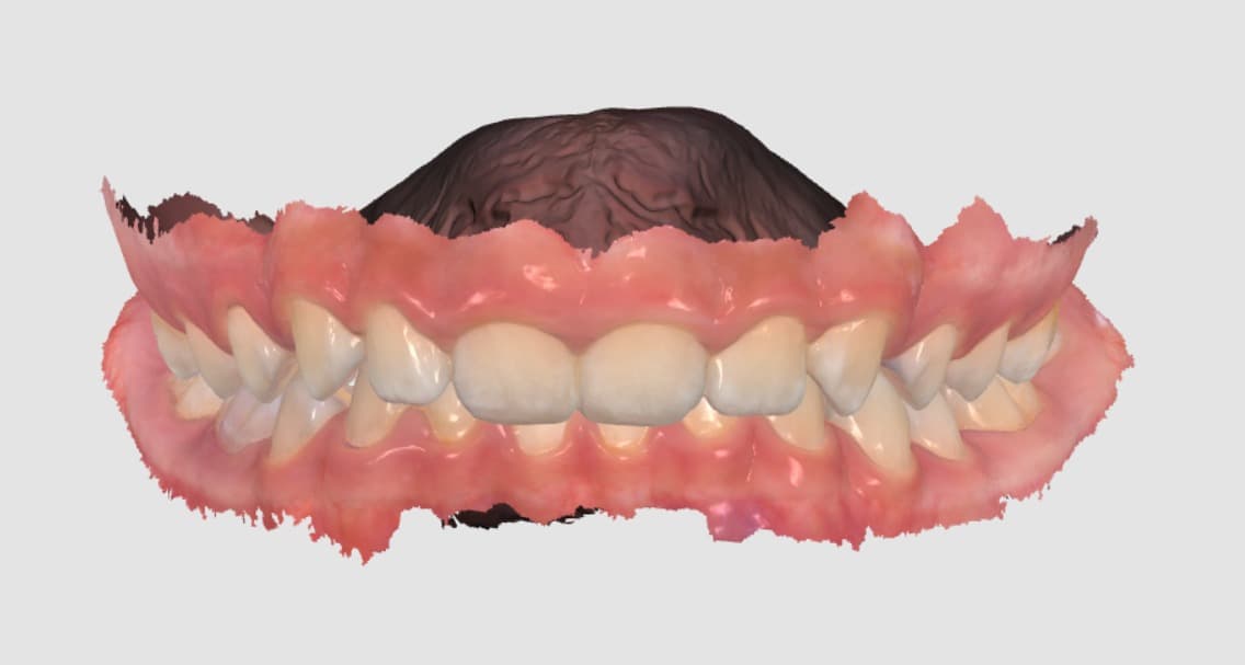 Escaneo intraoral 3D