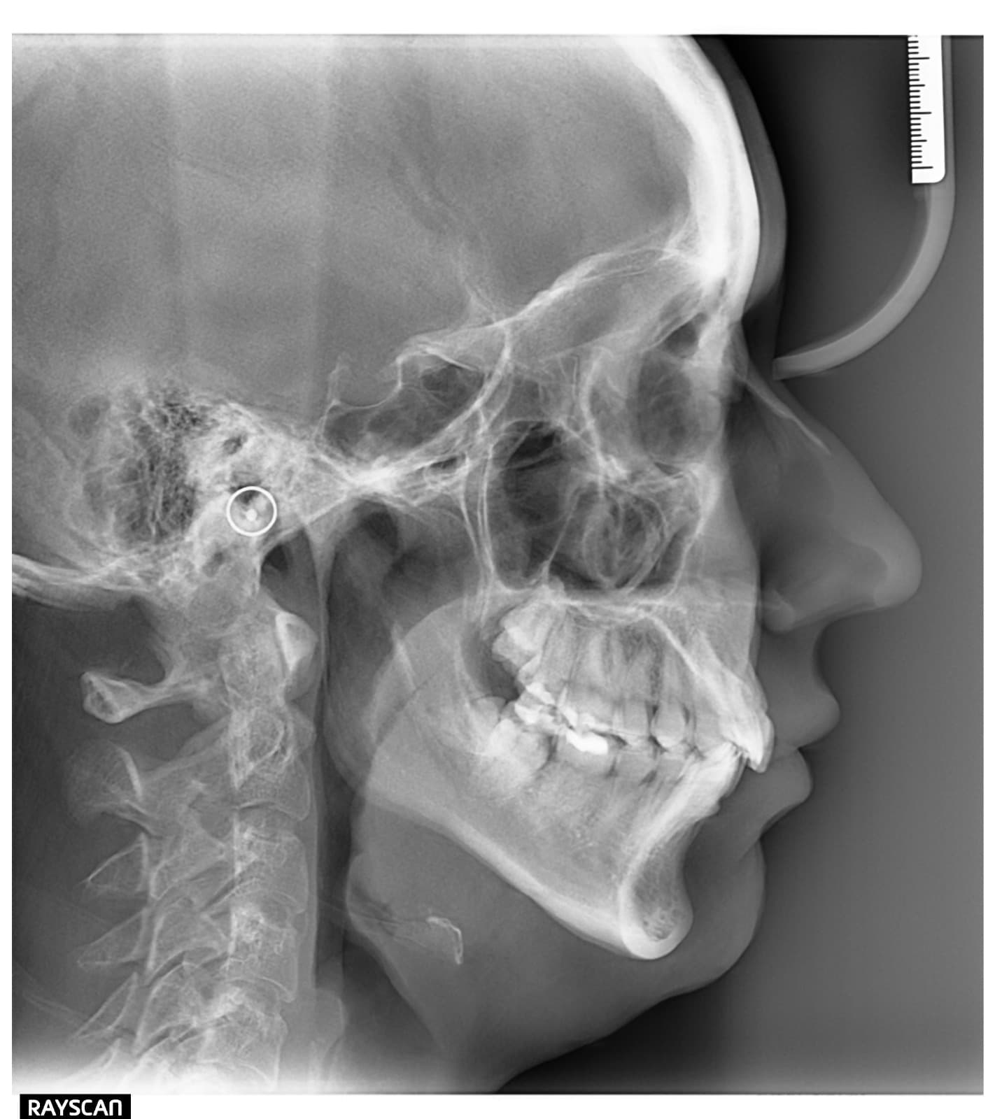 Radiografía cefalométrica lateral 2D