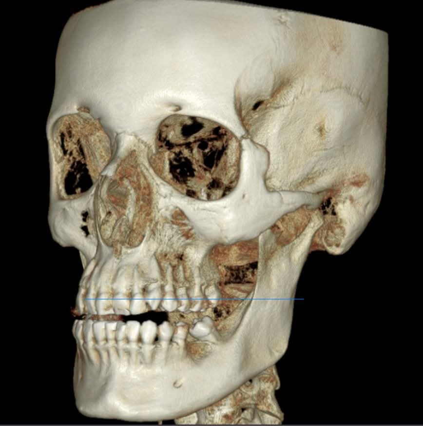 Tomografía CBCT craneofacial 3D