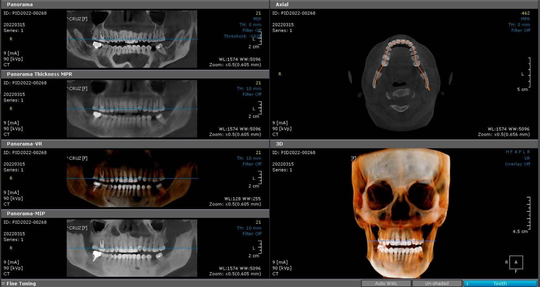 Tomografía dental CBCT multiplanar